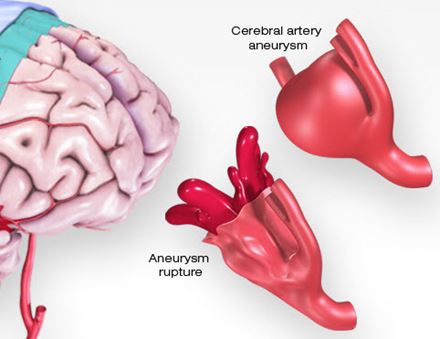 medical illustration of an aneurysm medical illustration of an aneurysm